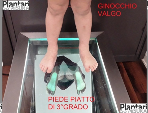 Piede piatto 3° nel bambino